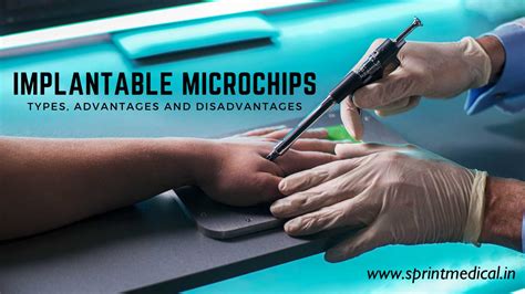 rfid chip in human|Microchip implant (human) .